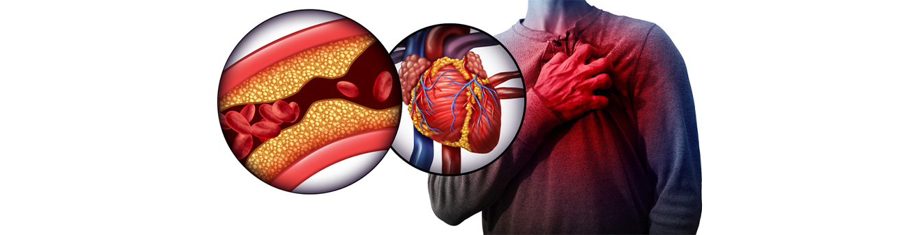 Coronary Artery Disease: Is your heart as healthy as you think?
